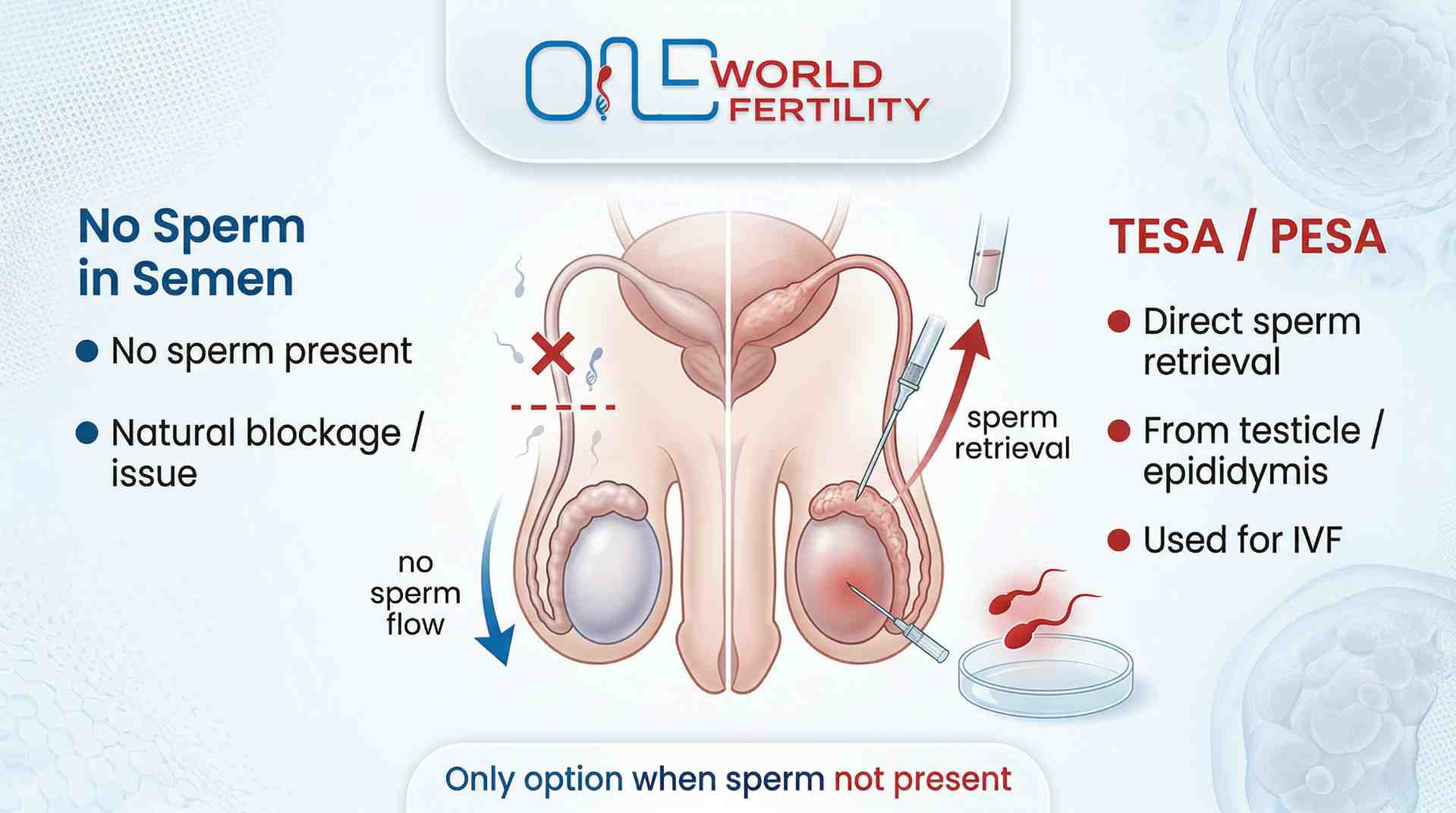 TESA  PESA - Getting Sperm Directly from the Body - one world fertility.jpeg